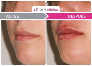 antes despues aumento labios cordoba